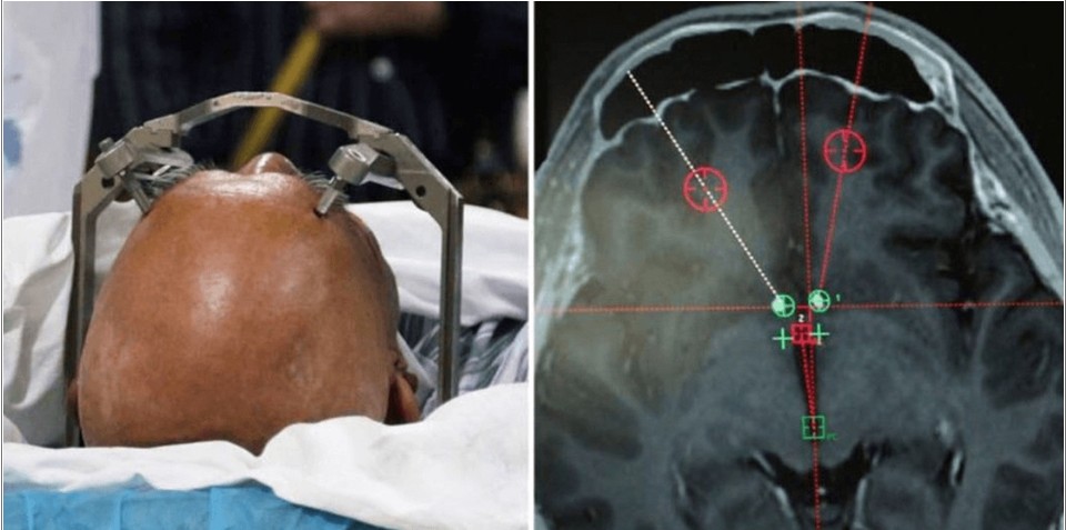 neuroestimulación invasiva